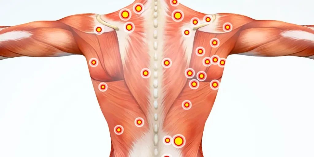 Illustration of the back muscles with multiple red target points indicating areas of musculoskeletal pain, highlighting trigger points across the upper back, shoulders, and spine.