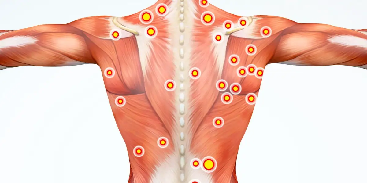 Illustration of the back muscles with multiple red target points indicating areas of musculoskeletal pain, highlighting trigger points across the upper back, shoulders, and spine.