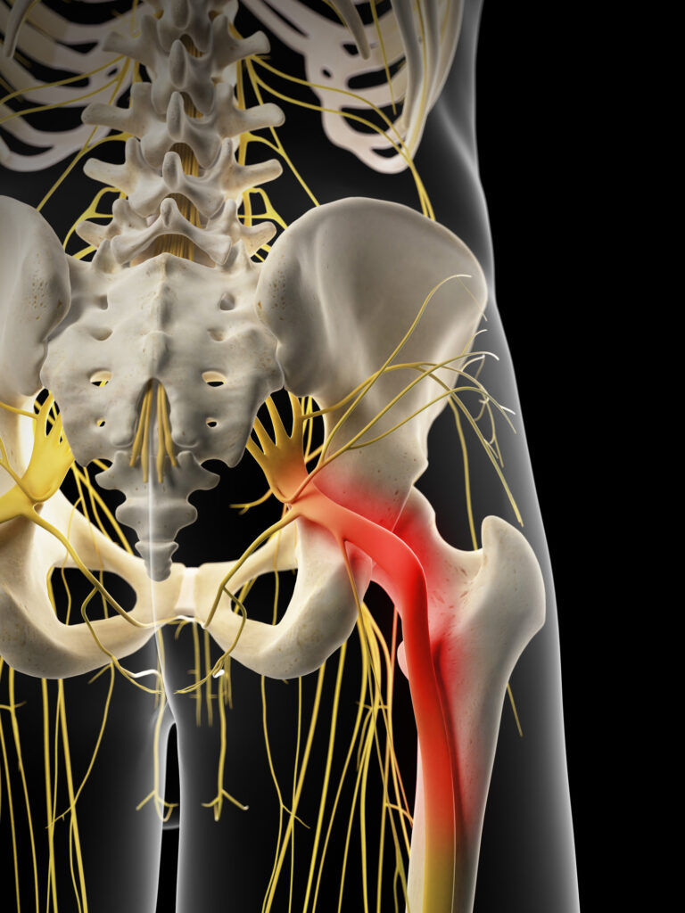 The sciatic nerve highlighted in red to show inflammation, illustrating sciatica pain.